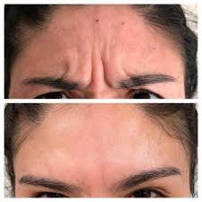 WRINKLES IN FOREHEAD